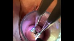 Endocervical speculum Thumb